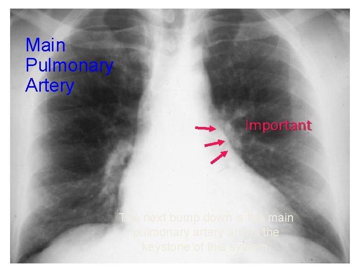 Main Pulmonary Artery Important The next bump down is the main pulmonary artery and