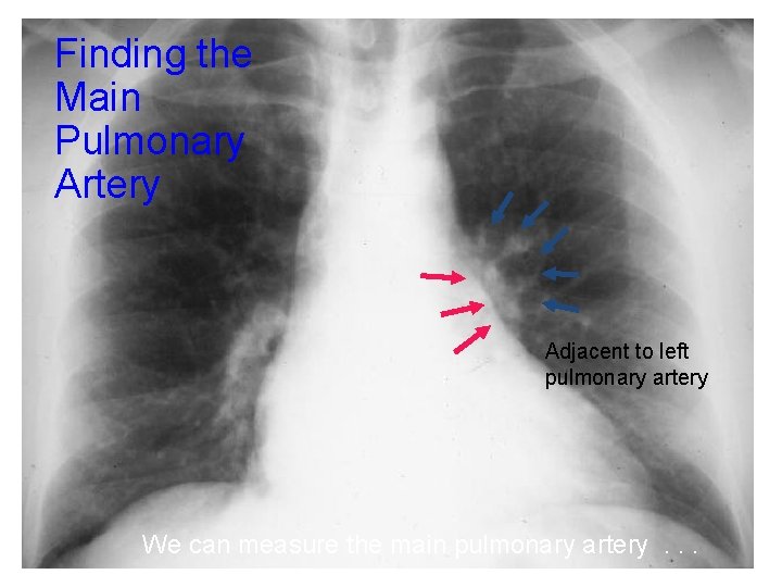 Finding the Main Pulmonary Artery Adjacent to left pulmonary artery We can measure the