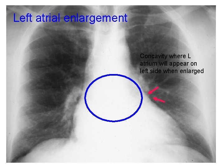 Left atrial enlargement Concavity where L atrium will appear on left side when enlarged