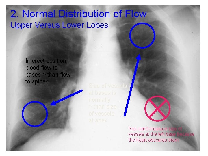 2. Normal Distribution of Flow Upper Versus Lower Lobes In erect position, blood flow