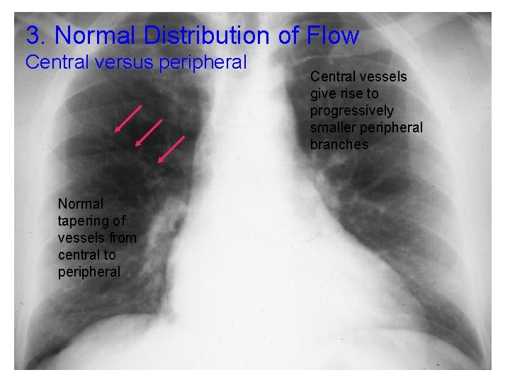 3. Normal Distribution of Flow Central versus peripheral Normal tapering of vessels from central