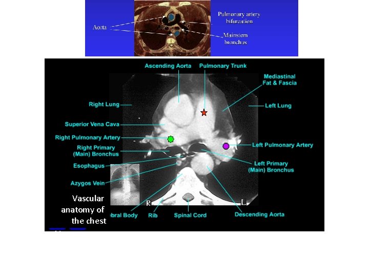 Vascular anatomy of the chest 