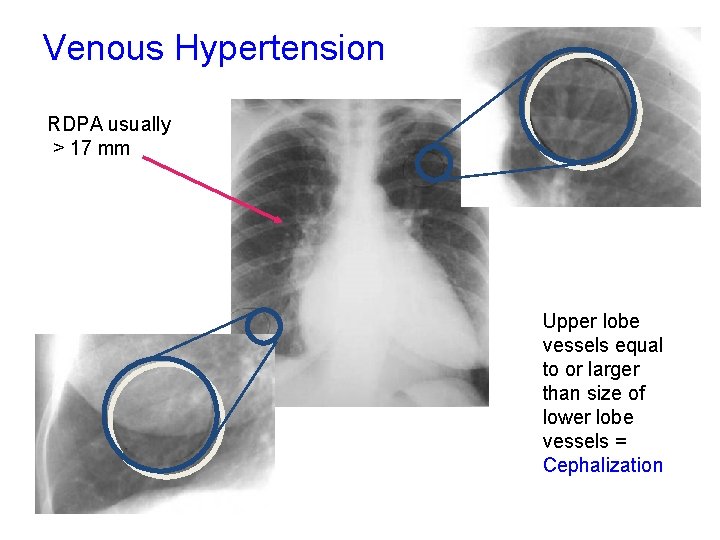Venous Hypertension RDPA usually > 17 mm Upper lobe vessels equal to or larger