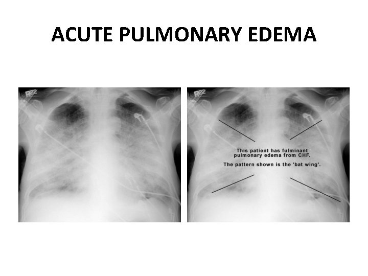 ACUTE PULMONARY EDEMA 