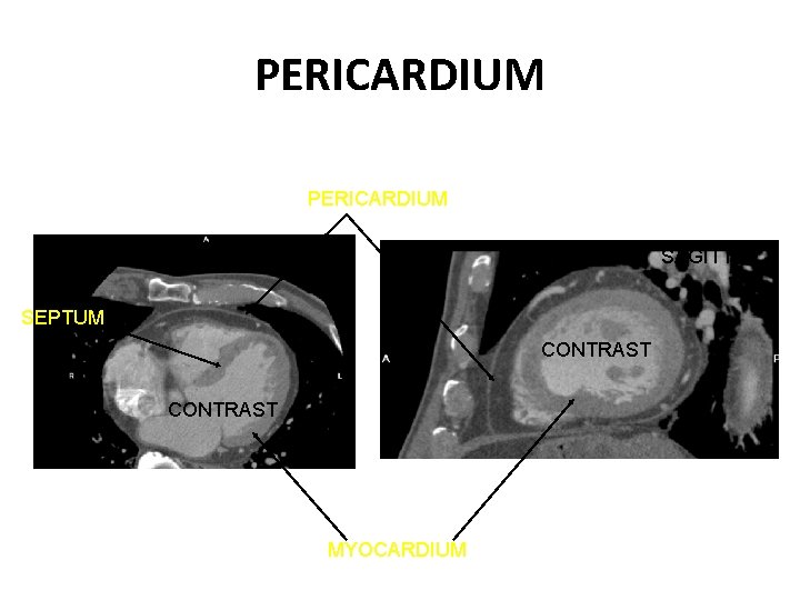 PERICARDIUM AXIAL SAGITTAL SEPTUM CONTRAST MYOCARDIUM 