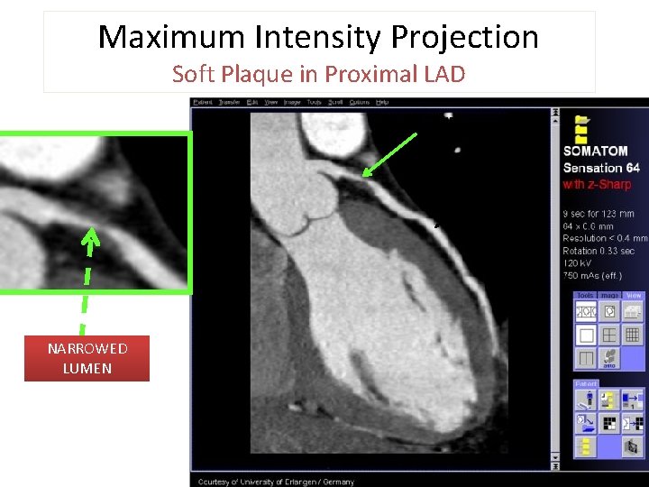 Maximum Intensity Projection Soft Plaque in Proximal LAD PLAQUE NORMAL NARROWED LUMEN 