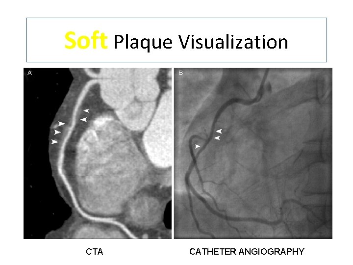Soft Plaque Visualization CTA CATHETER ANGIOGRAPHY 
