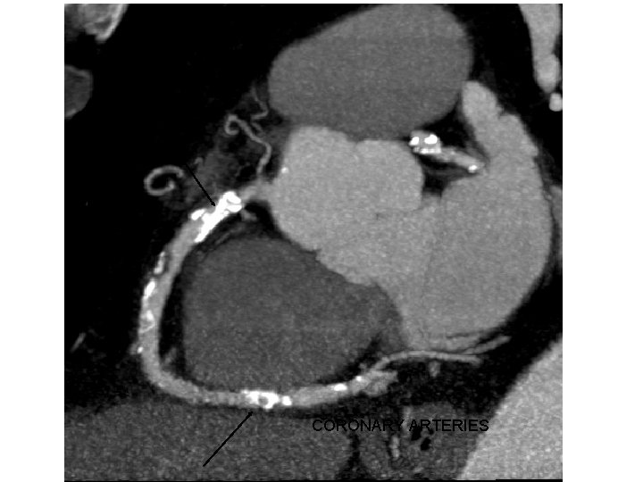 CALCIFIC PLAQUES CORONARY ARTERIES 