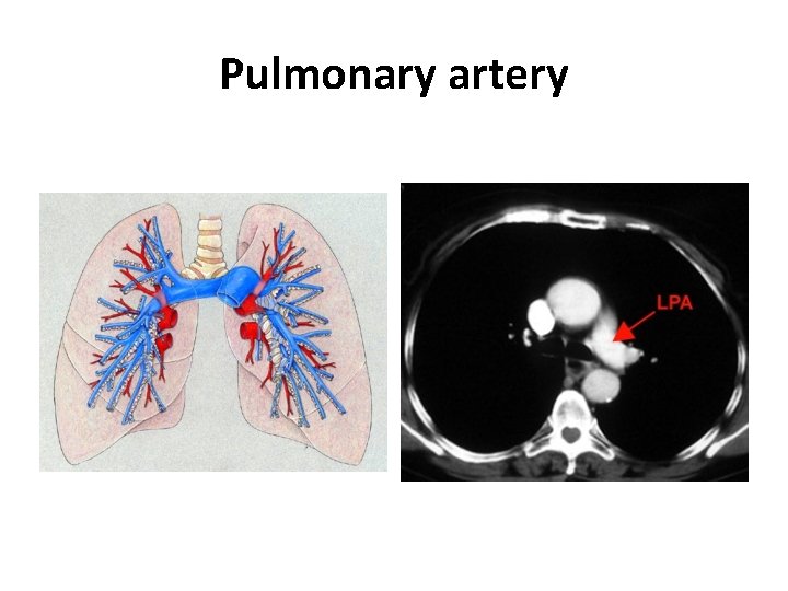 Pulmonary artery 