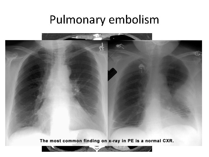 Pulmonary embolism 