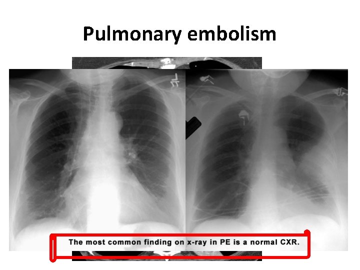 Pulmonary embolism 