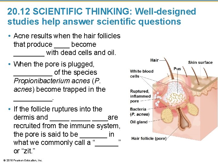 20. 12 SCIENTIFIC THINKING: Well-designed studies help answer scientific questions • Acne results when