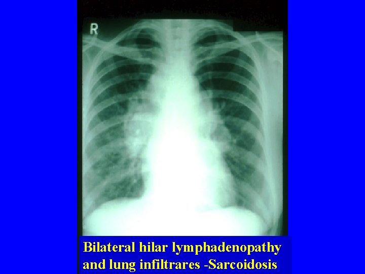 Bilateral hilar lymphadenopathy and lung infiltrares -Sarcoidosis 