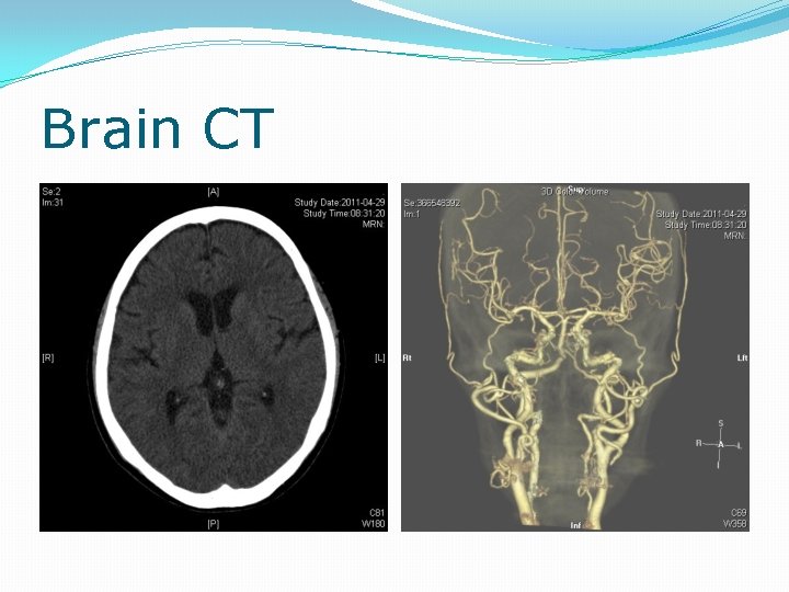 Brain CT 