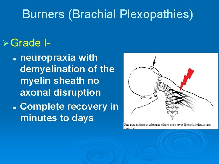 Burners (Brachial Plexopathies) Ø Grade I- neuropraxia with demyelination of the myelin sheath no
