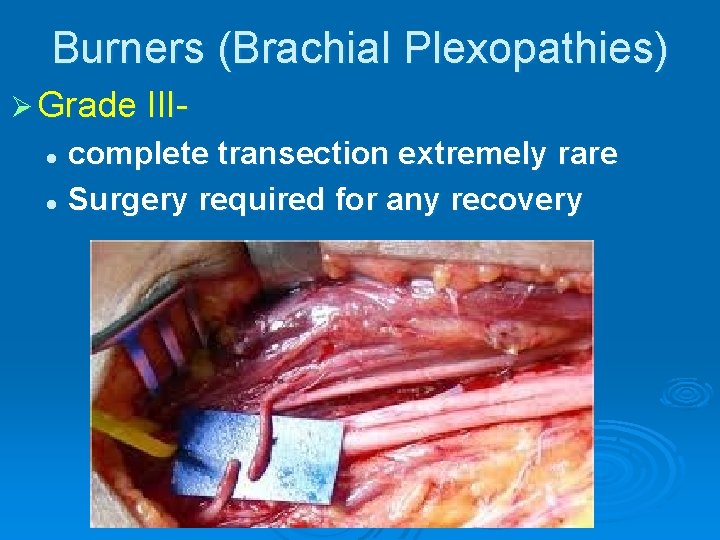 Burners (Brachial Plexopathies) Ø Grade III- complete transection extremely rare l Surgery required for