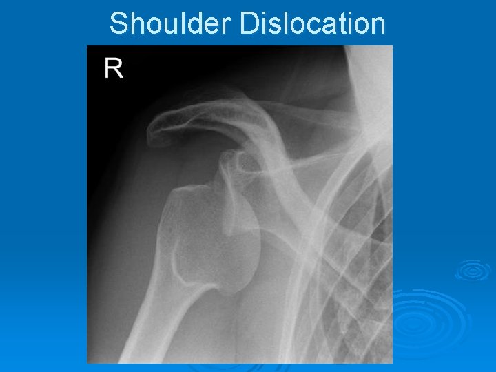 Shoulder Dislocation 