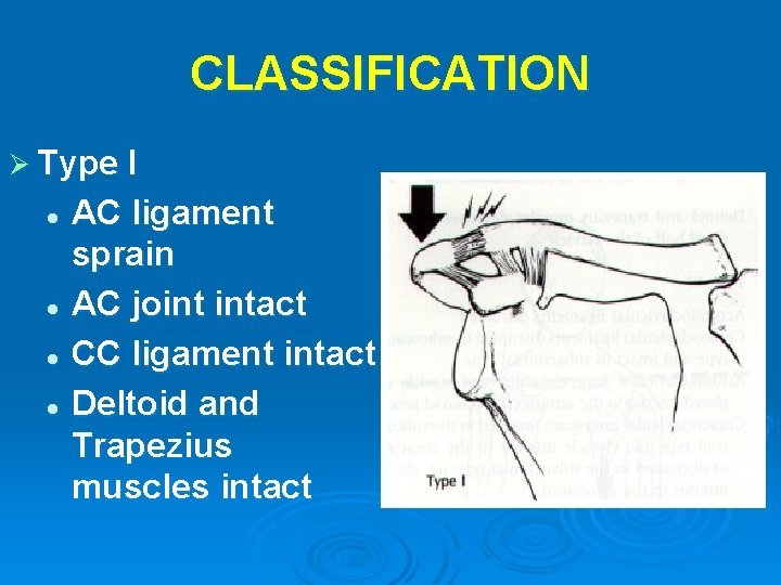 CLASSIFICATION Ø Type I AC ligament sprain l AC joint intact l CC ligament