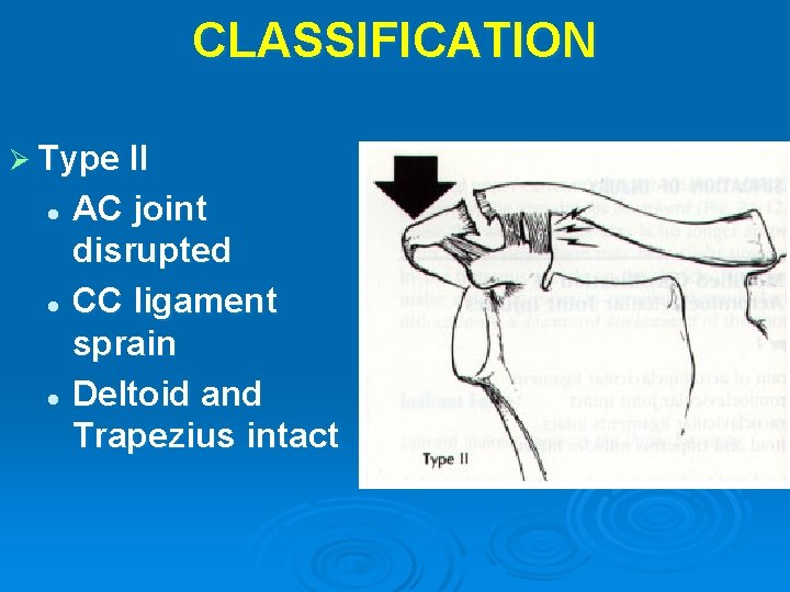 CLASSIFICATION Ø Type II AC joint disrupted l CC ligament sprain l Deltoid and