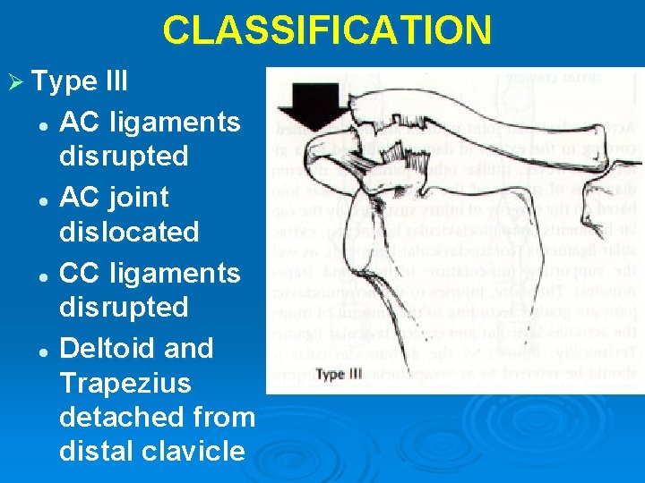 CLASSIFICATION Ø Type III AC ligaments disrupted l AC joint dislocated l CC ligaments