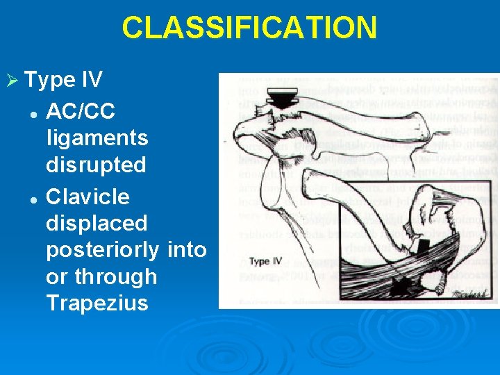 CLASSIFICATION Ø Type IV AC/CC ligaments disrupted l Clavicle displaced posteriorly into or through