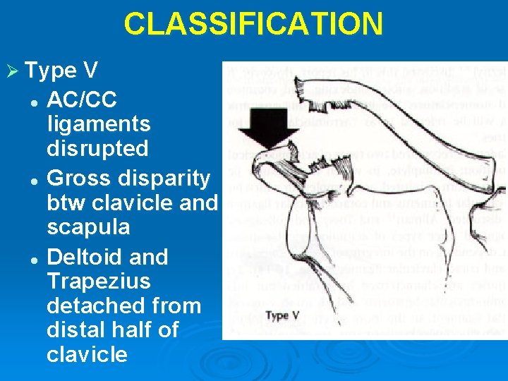 CLASSIFICATION Ø Type V AC/CC ligaments disrupted l Gross disparity btw clavicle and scapula