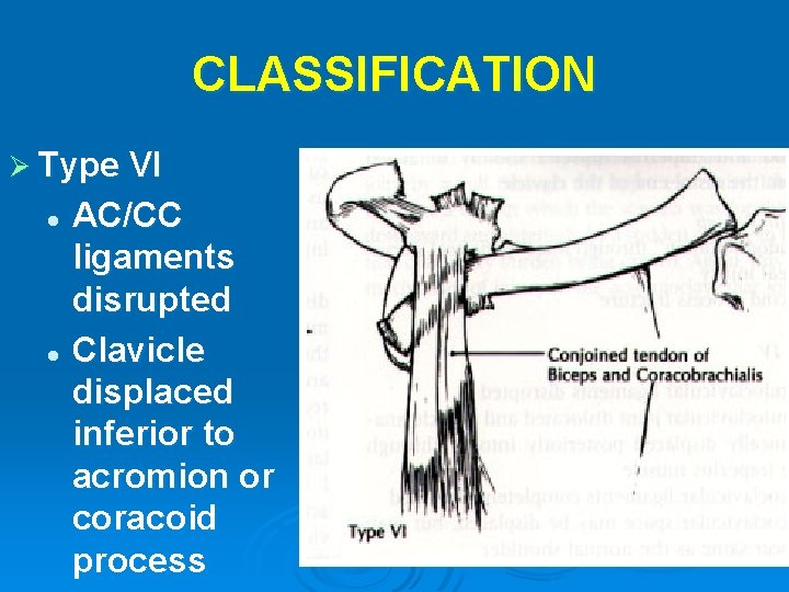 CLASSIFICATION Ø Type VI AC/CC ligaments disrupted l Clavicle displaced inferior to acromion or