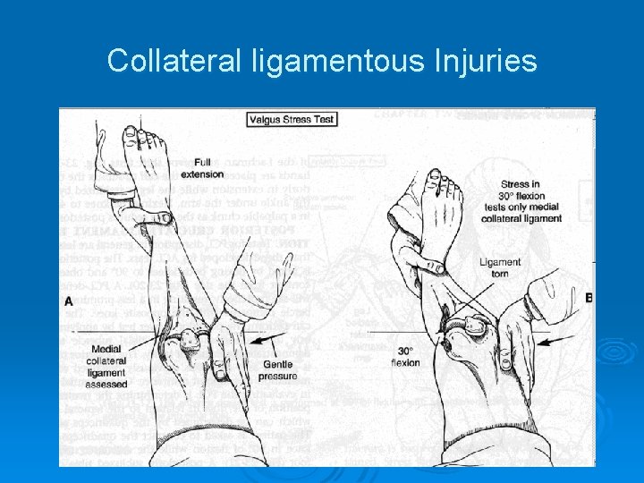 Collateral ligamentous Injuries 