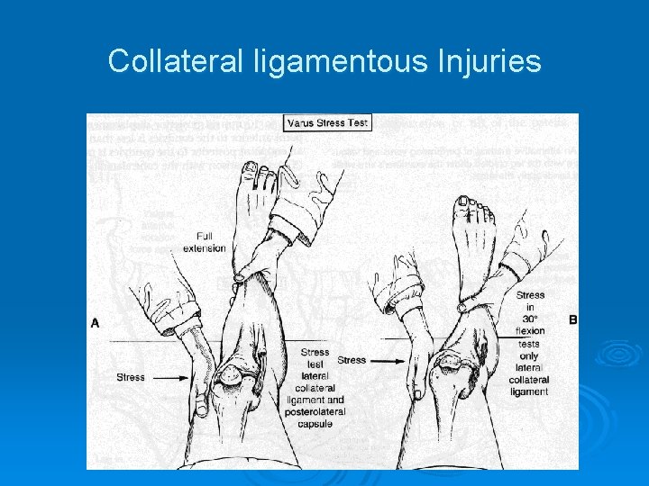 Collateral ligamentous Injuries 