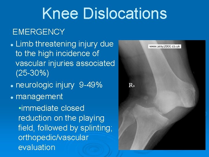 Knee Dislocations EMERGENCY l Limb threatening injury due to the high incidence of vascular