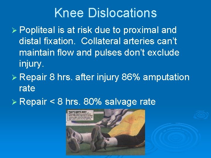 Knee Dislocations Ø Popliteal is at risk due to proximal and distal fixation. Collateral
