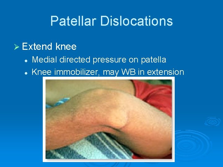 Patellar Dislocations Ø Extend knee l l Medial directed pressure on patella Knee immobilizer,