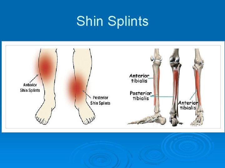 Shin Splints 