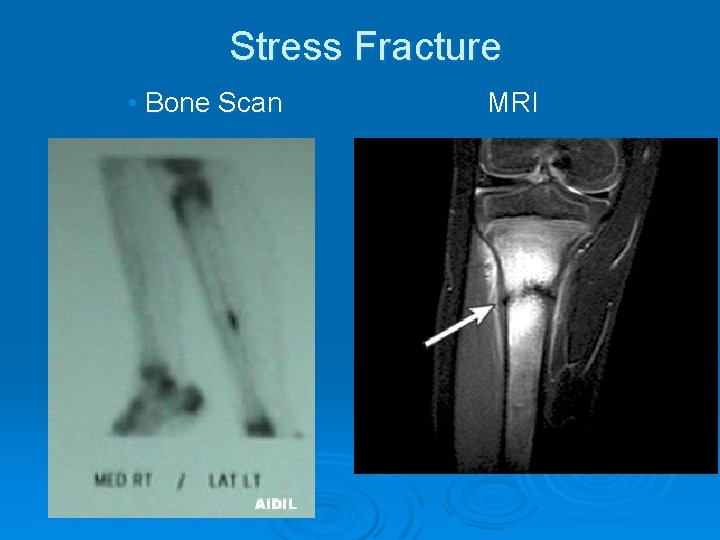 Stress Fracture • Bone Scan MRI 