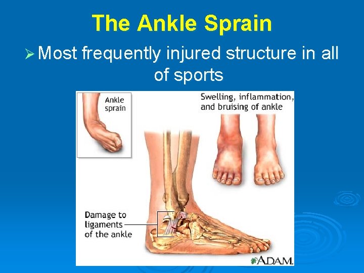 The Ankle Sprain Ø Most frequently injured structure in all of sports 