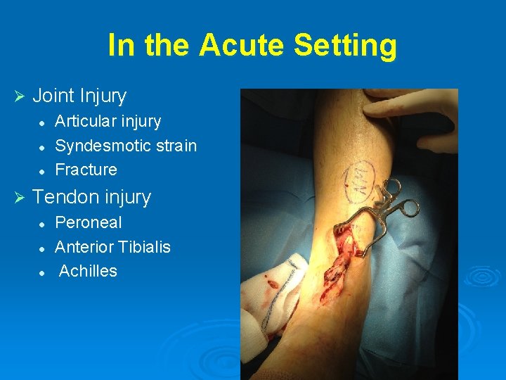 In the Acute Setting Ø Joint Injury l l l Ø Articular injury Syndesmotic