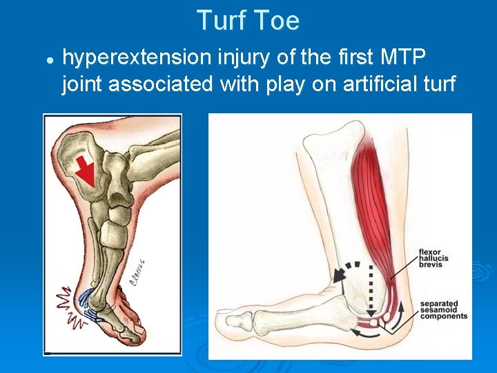 Turf Toe l hyperextension injury of the first MTP joint associated with play on