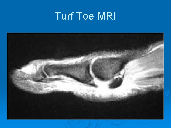Turf Toe MRI 