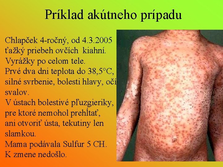 Príklad akútneho prípadu Chlapček 4 -ročný, od 4. 3. 2005 ťažký priebeh ovčích kiahní.