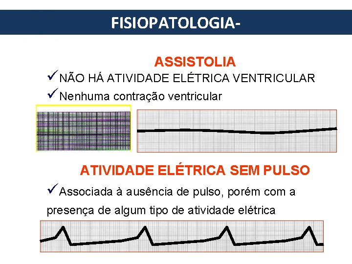 FISIOPATOLOGIA- European Resuscitation Council ASSISTOLIA üNÃO HÁ ATIVIDADE ELÉTRICA VENTRICULAR üNenhuma contração ventricular •