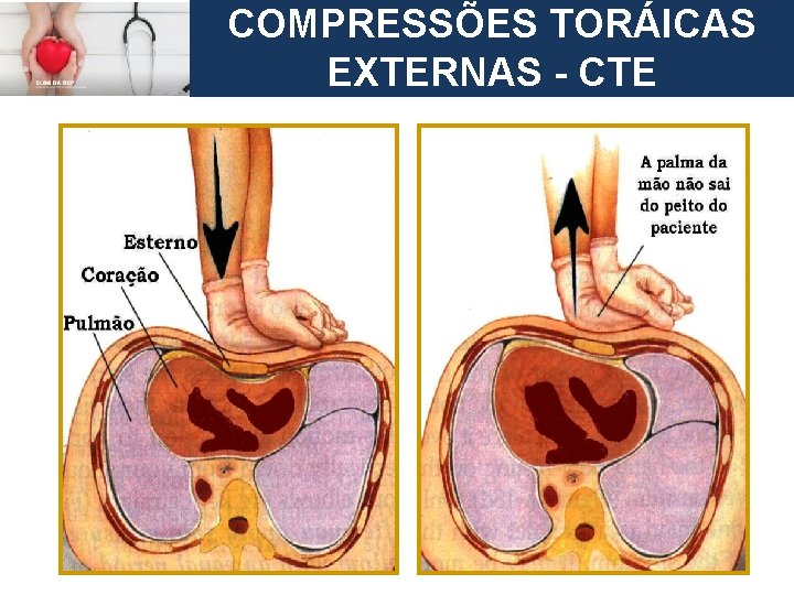 European Resuscitation Council COMPRESSÕES TORÁICASC CIRCULAÇÃO – Compressões EXTERNAS - CTE Torácicas 