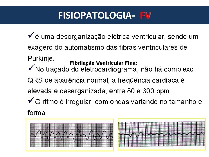 FISIOPATOLOGIA- FV European Resuscitation Council üé uma desorganização elétrica ventricular, sendo um exagero do