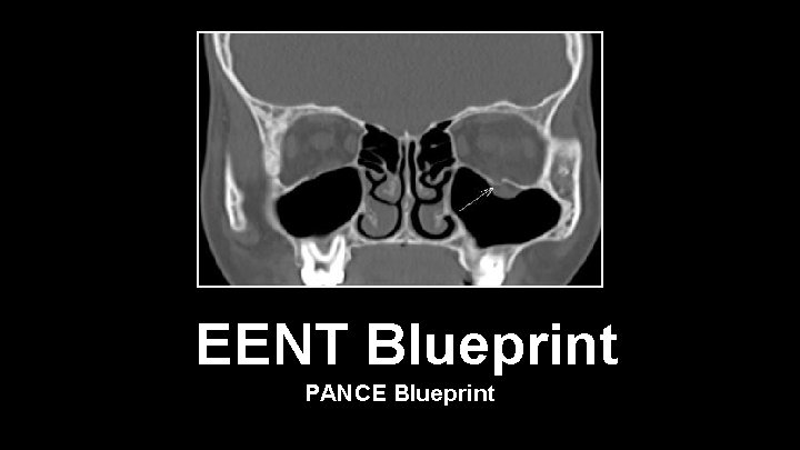 EENT Blueprint PANCE Blueprint 