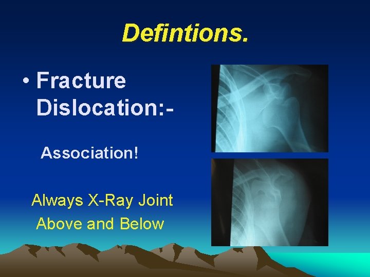 Defintions. • Fracture Dislocation: Association! Always X-Ray Joint Above and Below 