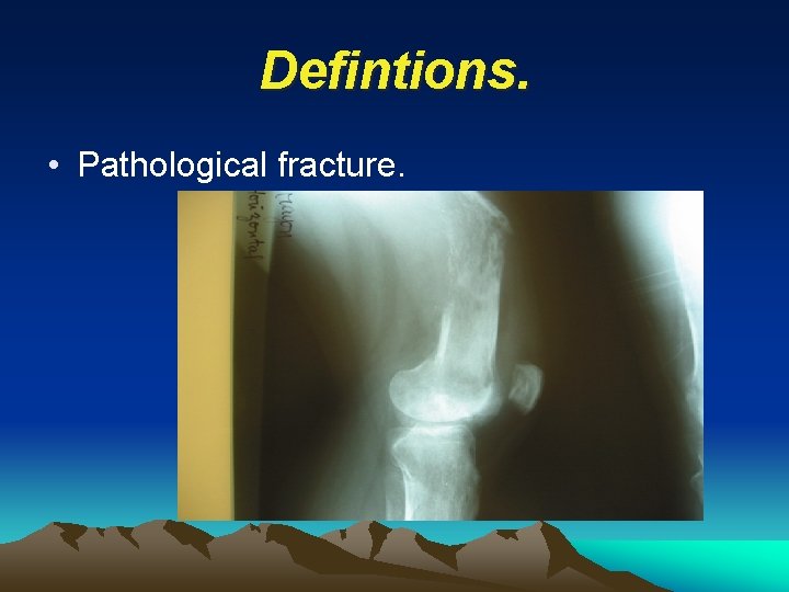 Defintions. • Pathological fracture. 