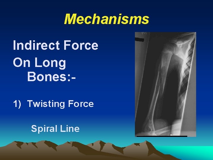 Mechanisms Indirect Force On Long Bones: 1) Twisting Force Spiral Line 