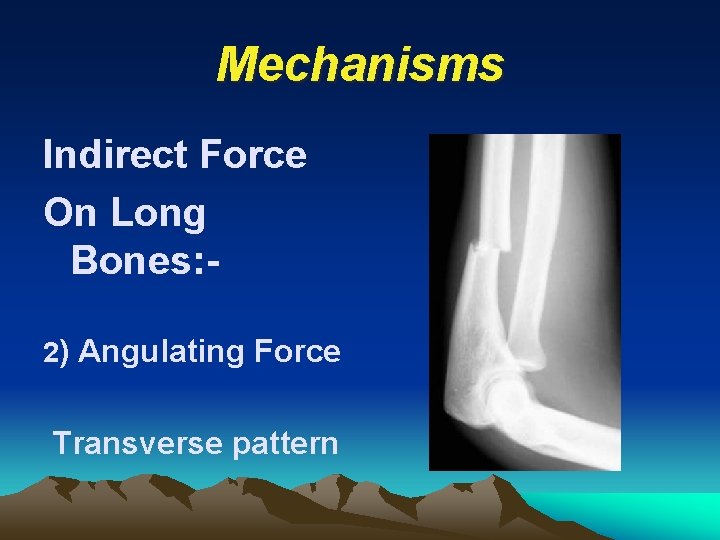 Mechanisms Indirect Force On Long Bones: 2) Angulating Force Transverse pattern 