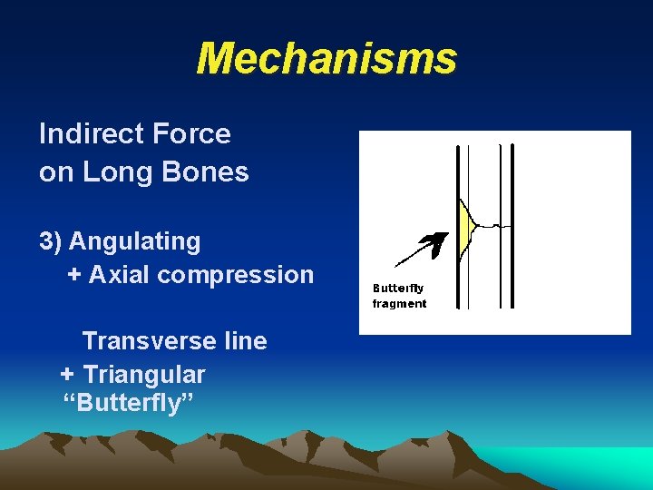 Mechanisms Indirect Force on Long Bones 3) Angulating + Axial compression Transverse line +