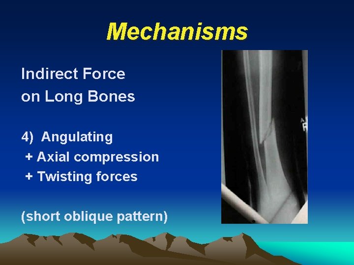 Mechanisms Indirect Force on Long Bones 4) Angulating + Axial compression + Twisting forces