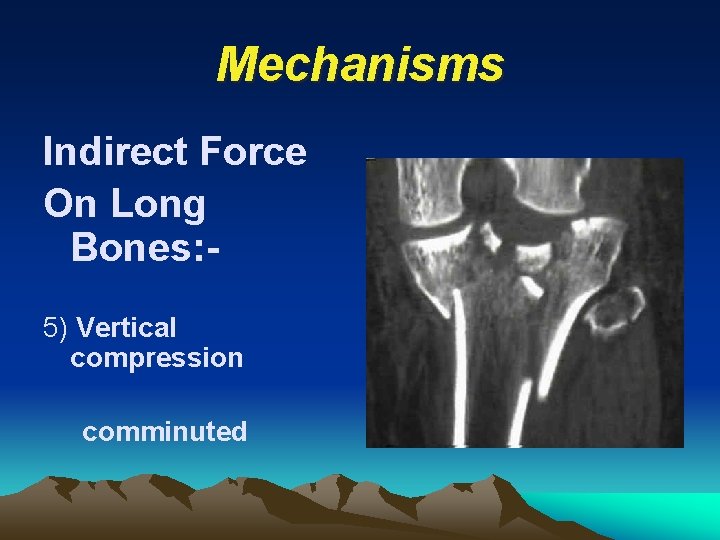 Mechanisms Indirect Force On Long Bones: 5) Vertical compression comminuted 